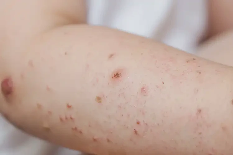 兒童身上容易長濕疹可不可以徹底自愈(圖4)