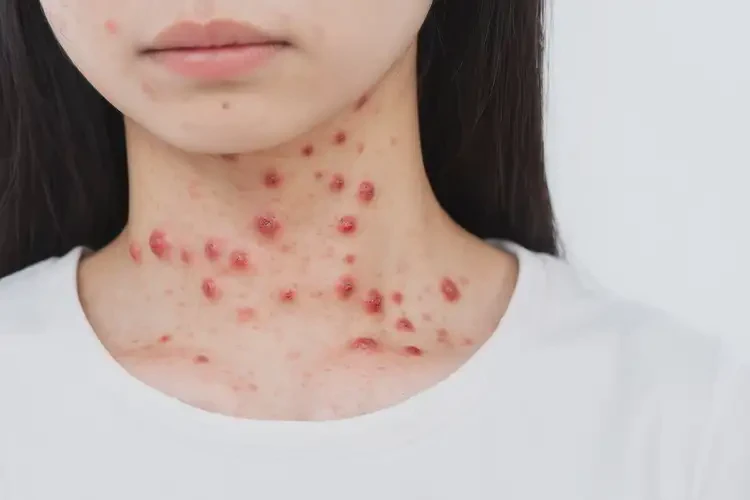 女生脖子上有湿疹可不可以彻底自愈(图4)