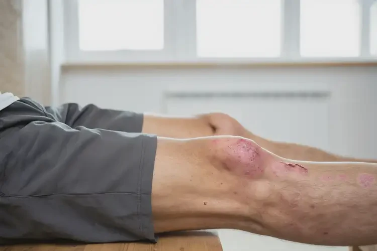 男性大腿上偶爾起濕疹不管它會(huì)自己自愈嗎(圖2)