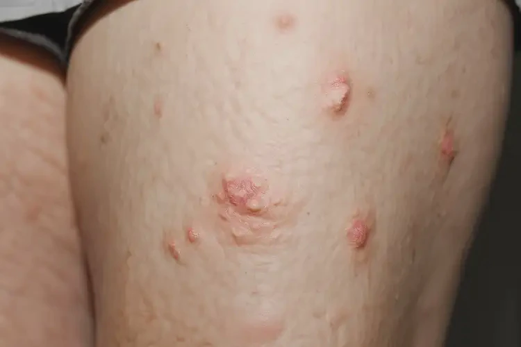 女性大腿起濕疹不管它會(huì)自己自愈嗎(圖4)