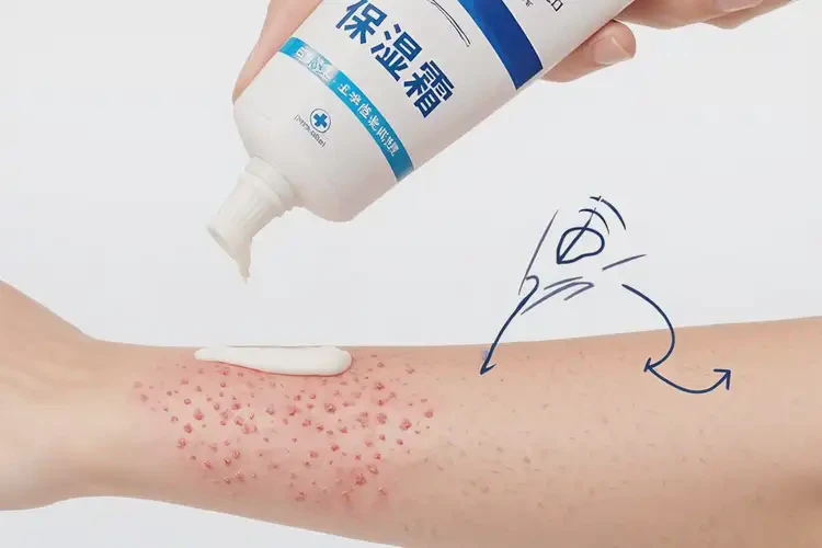 大學(xué)生手臂上出濕疹可以徹底自愈嗎(圖3)