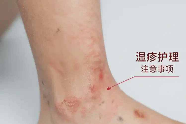 孩子腳上起濕疹不管它會自己好嗎(圖4)