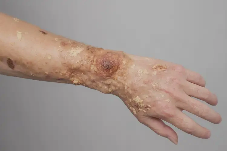 男生四肢出濕疹不管它會(huì)自己好嗎(圖2)