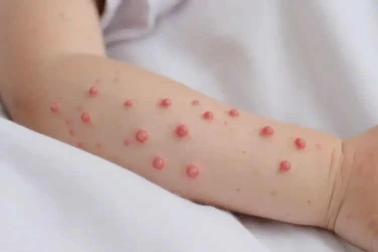 小學(xué)生身上偶爾起濕疹可以徹底自愈嗎(圖4)