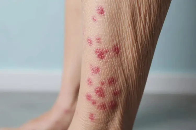 老年人小腿上出濕疹不管它會(huì)自己好嗎(圖4)