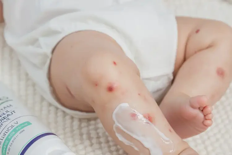 嬰兒小腿起濕疹不管它會(huì)自己痊愈嗎(圖3)