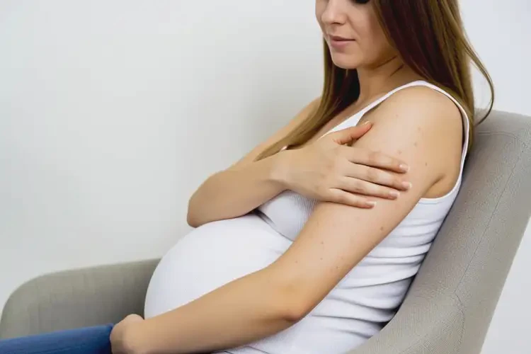 孕婦四肢有濕疹不管它會(huì)自己痊愈嗎(圖4)