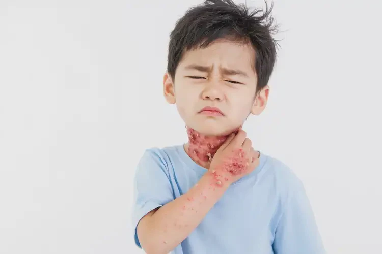 小孩脖子上容易長濕疹不管它會自己自愈嗎(圖4)