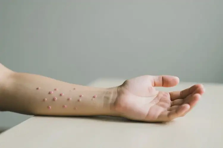 青年人手臂偶尔长湿疹能不能彻底自愈(图2)