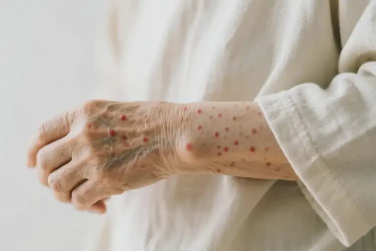 老人身上偶爾長濕疹能靠自己自愈嗎(圖3)