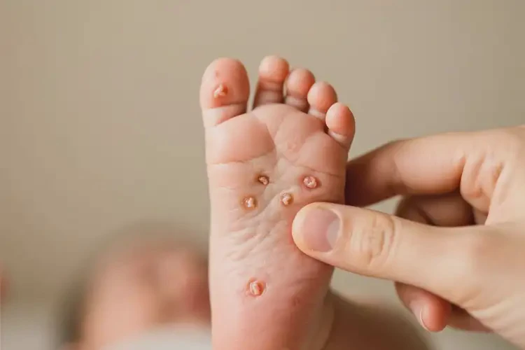 嬰幼兒腳上有濕疹不管它會(huì)自己痊愈嗎(圖1)