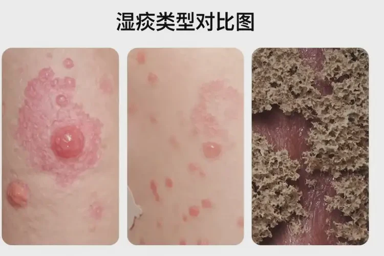 中学生身上偶尔起湿疹可以彻底自愈吗(图3)