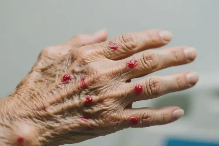 老人手上出現(xiàn)濕疹能夠徹底治愈嗎(圖2)