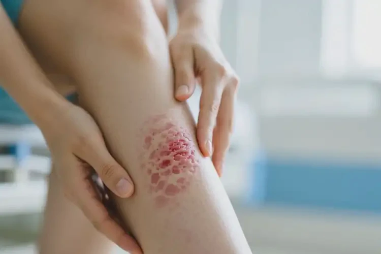 女人身上有濕疹不管它會(huì)自己自愈嗎(圖3)