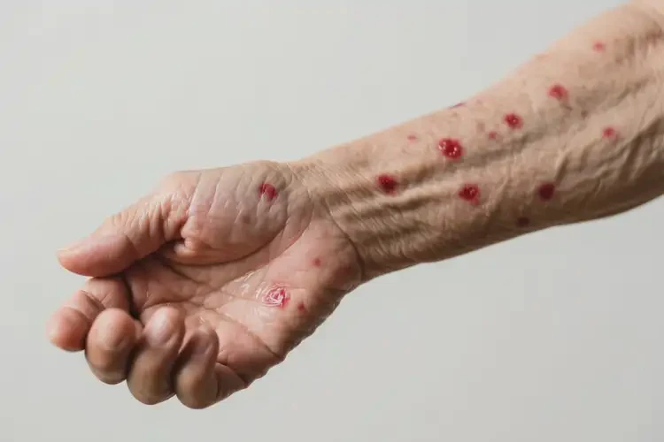 老年人手臂上出現(xiàn)濕疹能不能徹底自愈(圖2)