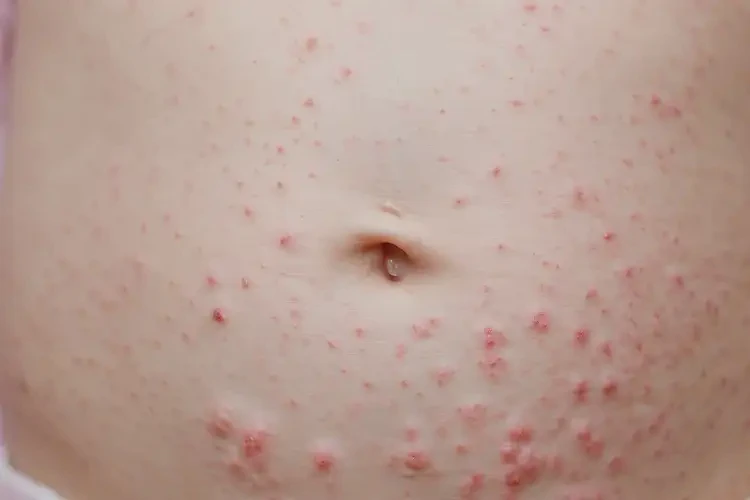 新生兒肚子上起濕疹可以徹底自愈嗎(圖4)