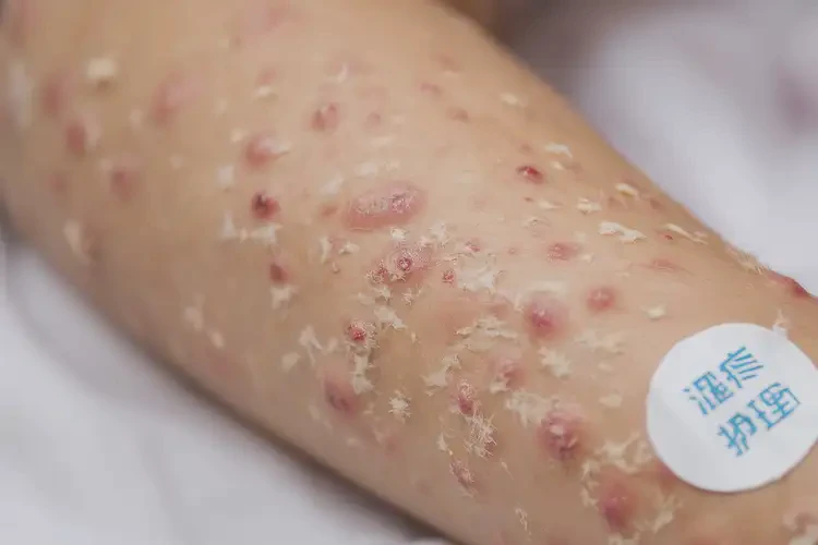 兒童全身經(jīng)常長濕疹可以徹底自愈嗎(圖4)