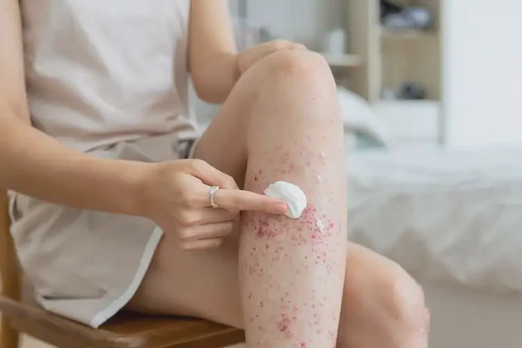 女性小腿上起濕疹可不可以徹底自愈(圖3)