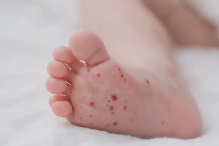 新生兒腳上偶爾起濕疹不管它會(huì)自己自愈嗎(圖3)