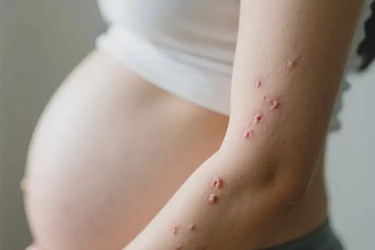 孕妇手臂上有湿疹可不可以彻底自愈(图2)