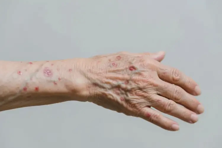 老年人手臂上偶爾起濕疹可以徹底自愈嗎(圖2)