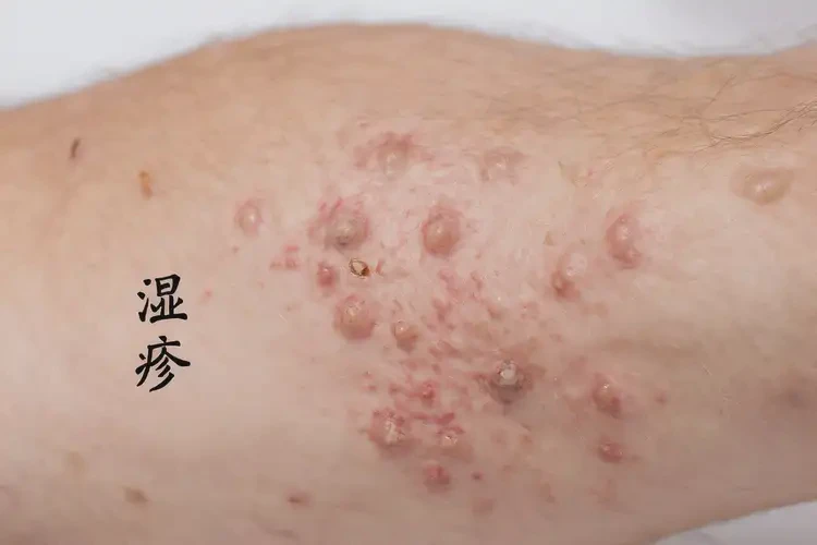 青年人手臂有湿疹能不能彻底自愈(图4)