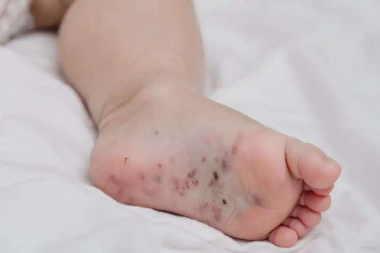 嬰兒小腿上經(jīng)常長(zhǎng)濕疹能夠徹底治愈嗎(圖3)