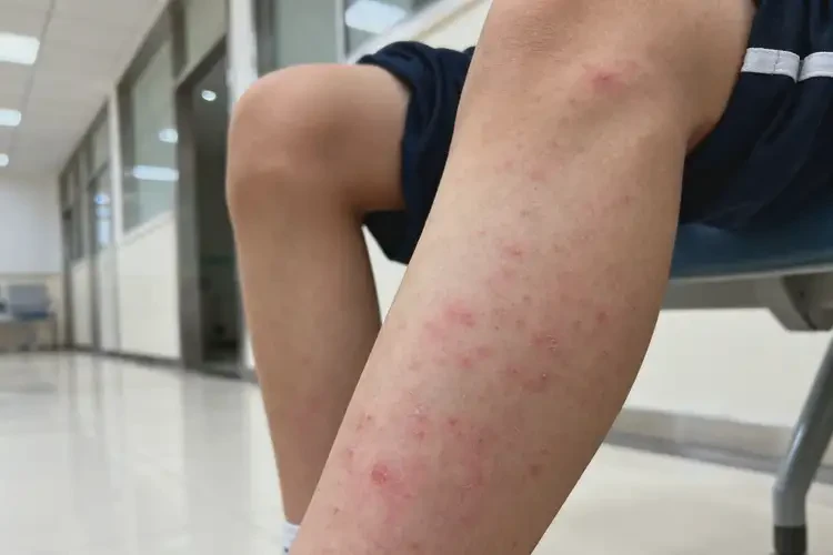 青少年小腿偶爾長濕疹可以徹底自愈嗎(圖4)