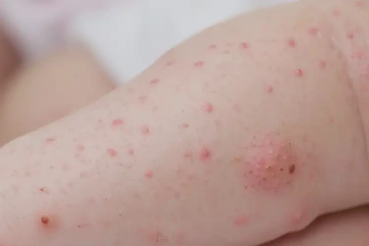 孩子屁股偶爾起濕疹能夠徹底治愈嗎(圖4)