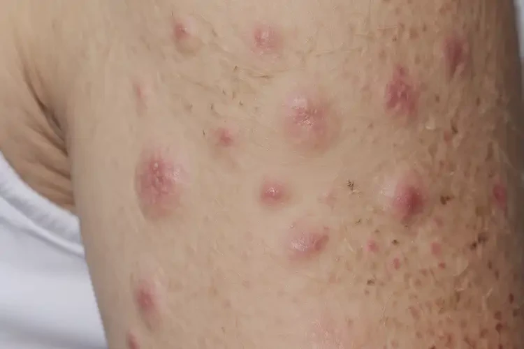 女人手臂起濕疹可不可以徹底自愈(圖4)