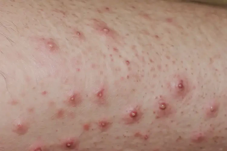 男人大腿長濕疹能徹底自愈嗎(圖4)