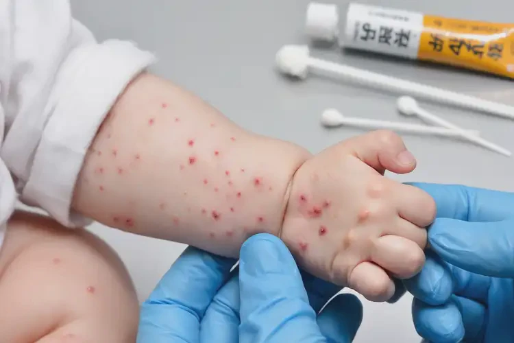 幼兒手臂出濕疹能夠徹底治愈嗎(圖4)