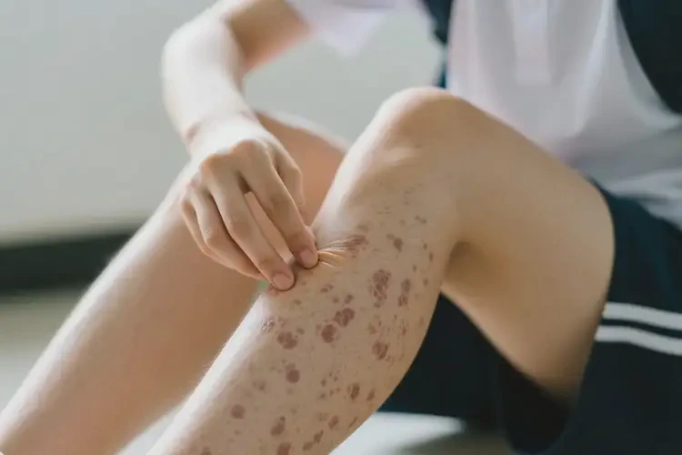 大学生小腿出湿疹不管它会自己痊愈吗(图2)