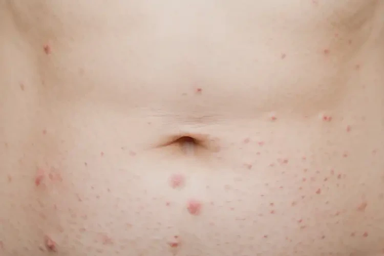 女性肚子上有濕疹能靠自己自愈嗎(圖4)