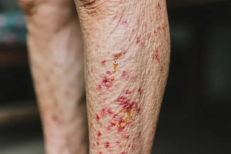 老年人小腿出現(xiàn)濕疹能徹底自愈嗎(圖3)