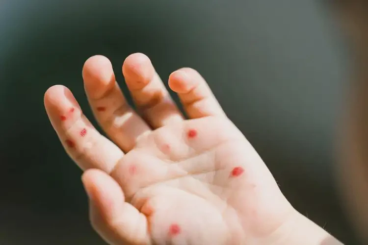 小孩手上偶爾長(zhǎng)濕疹不管它會(huì)自己痊愈嗎(圖4)