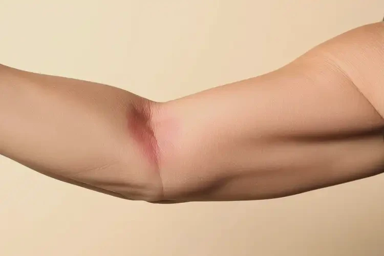 老年人手臂上出現(xiàn)濕疹能不能徹底自愈(圖4)