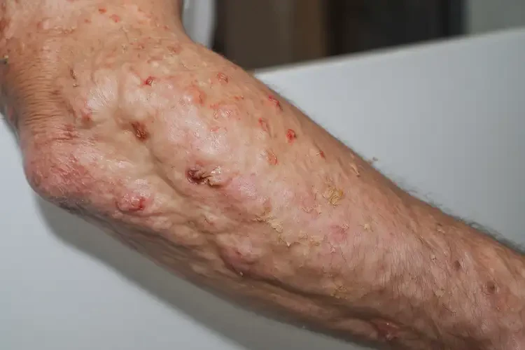 男性手臂長濕疹能夠徹底治愈嗎(圖4)