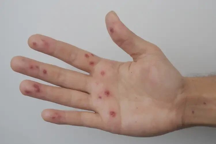 大學(xué)生手上出現(xiàn)濕疹不管它會(huì)自己痊愈嗎(圖4)