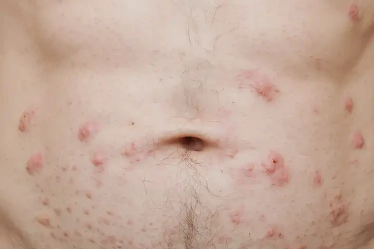 男性肚子上起濕疹能夠徹底治愈嗎(圖4)