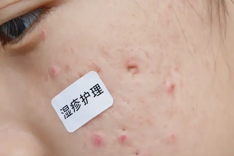 青少年脸上长湿疹可以彻底自愈吗(图4)