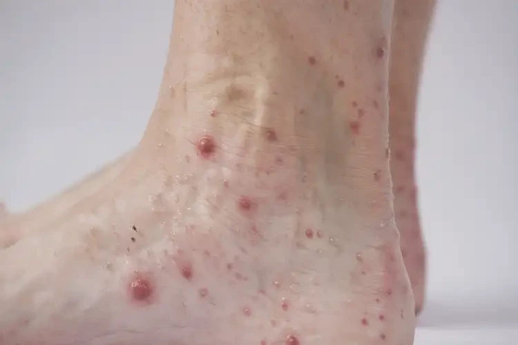 青少年腳上經(jīng)常長濕疹不管它會自己自愈嗎(圖4)