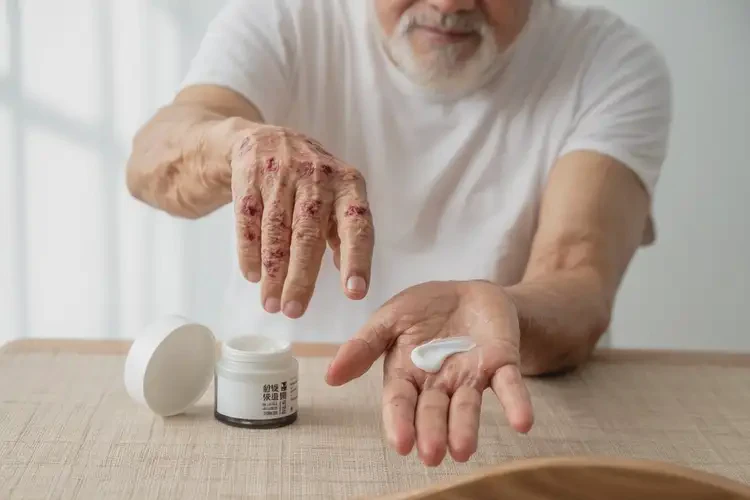高齡老人手上經(jīng)常長濕疹能夠徹底治愈嗎(圖3)