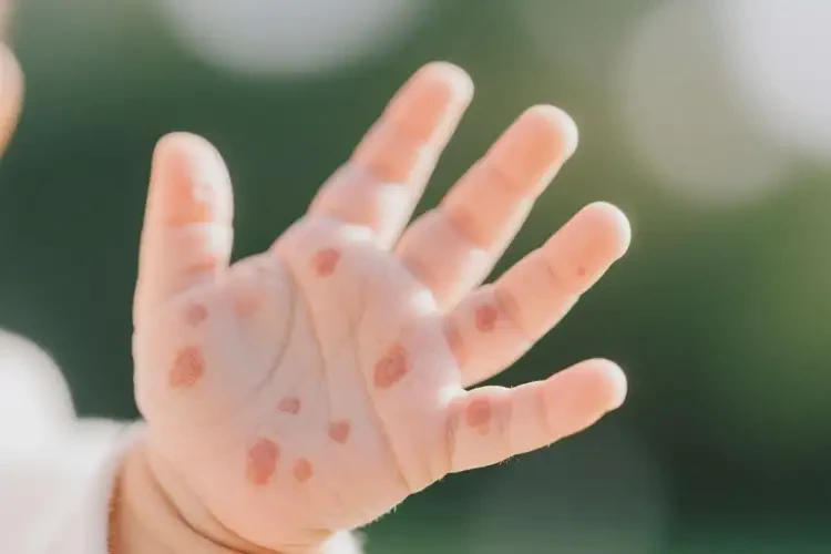 婴儿身上长湿疹不管它会自己痊愈吗(图4)