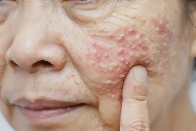 女性屁股上出濕疹不管它會自己自愈嗎(圖4)