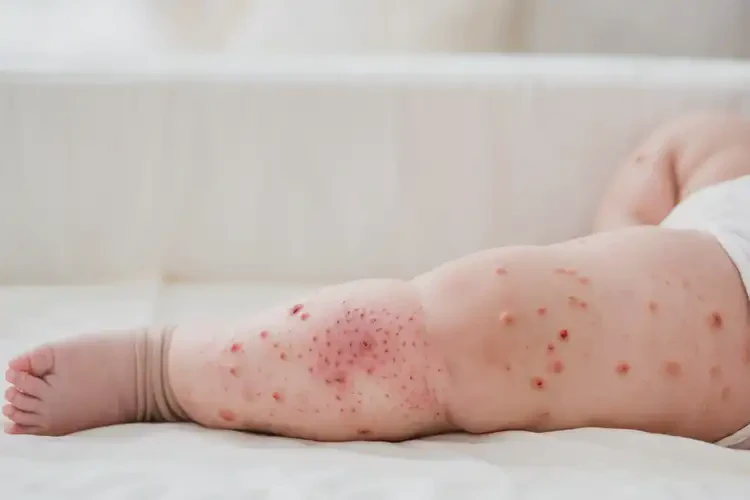 寶寶大腿容易長(zhǎng)濕疹不管它會(huì)自己痊愈嗎(圖4)