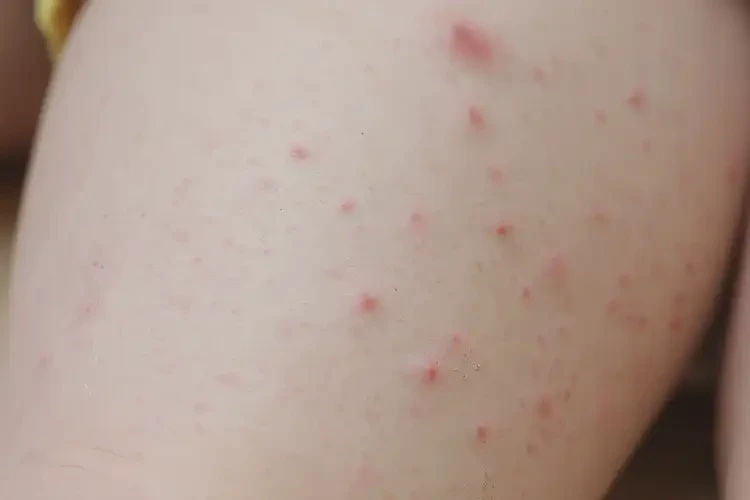 小兒大腿上偶爾長濕疹能徹底自愈嗎(圖4)