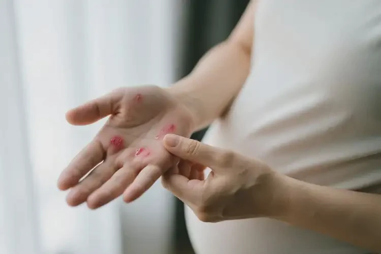 孕婦手上偶爾長濕疹可不可以徹底自愈(圖1)