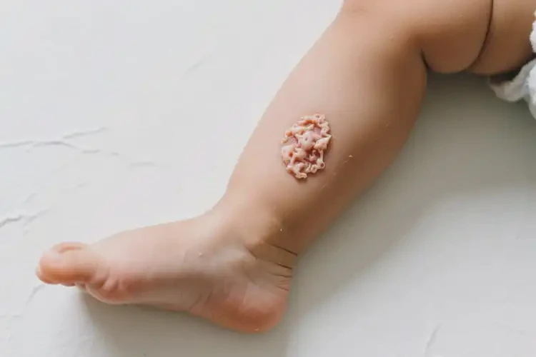 幼兒小腿上出現(xiàn)濕疹不管它會(huì)自己痊愈嗎(圖2)