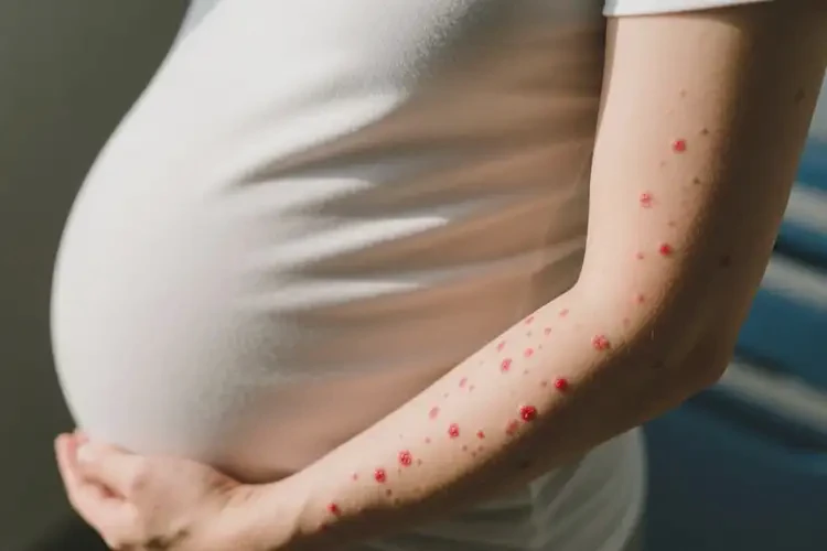 孕婦手臂經(jīng)常起濕疹能夠徹底治愈嗎(圖2)